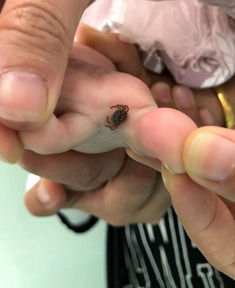 2岁女孩脚趾间多了颗"黑痣",妈妈发现真相让人汗毛倒竖