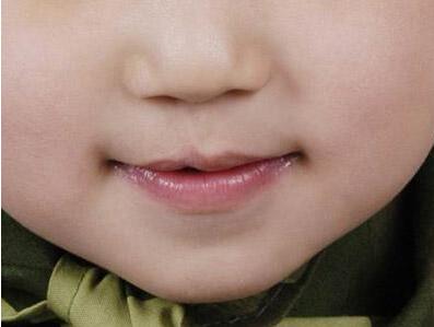 专家唇腭裂最佳修复时间36个月